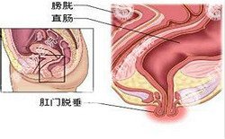 南寧治療脫肛哪家醫(yī)院好？南寧脫肛治療多少錢？